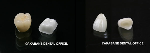 ジルコニアオールセラミッククラウン