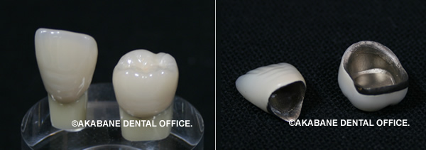 メタルボンドクラウン