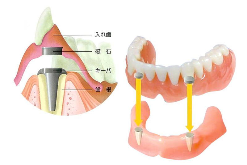 マグネットデンチャー